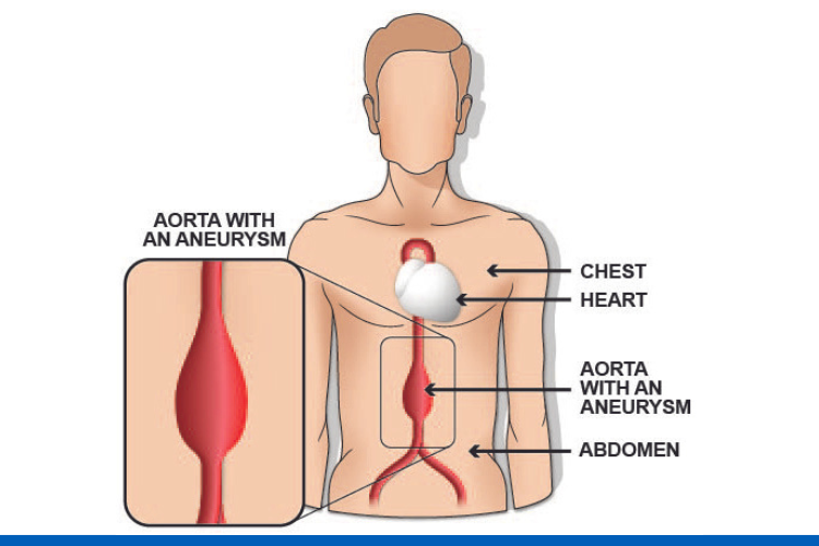 NHS in Gateshead secures contract for AAA screening programme across ...