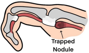 Trigger Finger Node Trigger Finger/Thumb Release Surgery - Gateshead Health